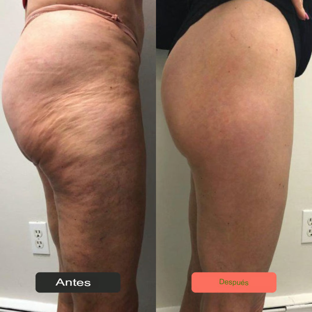 Diorah Cellulite Eliminator No. 1